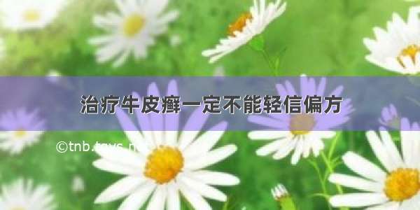 治疗牛皮癣一定不能轻信偏方