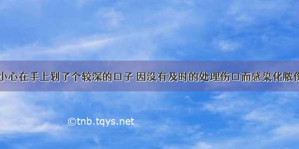 王康同学不小心在手上划了个较深的口子 因没有及时的处理伤口而感染化脓伤口中脓液的