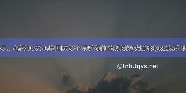 病人 男 45岁。心悸10天 心电图示多个导联提前出现的宽大畸形QRS波群 其前无相关P