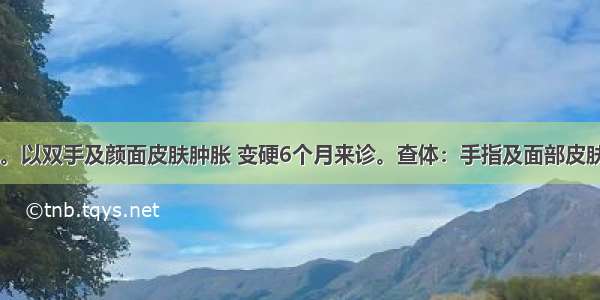 女性 49岁。以双手及颜面皮肤肿胀 变硬6个月来诊。查体：手指及面部皮肤增厚 皮肤