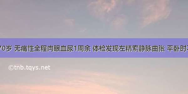 男性 70岁 无痛性全程肉眼血尿1周余 体检发现左精索静脉曲张 平卧时不消失