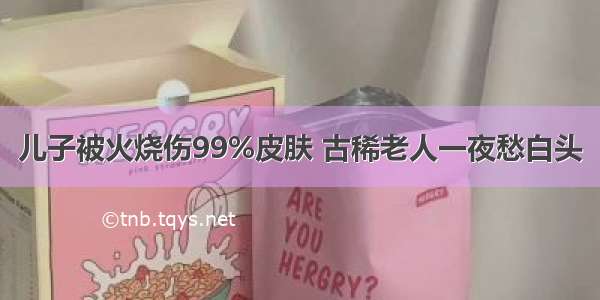 儿子被火烧伤99%皮肤 古稀老人一夜愁白头