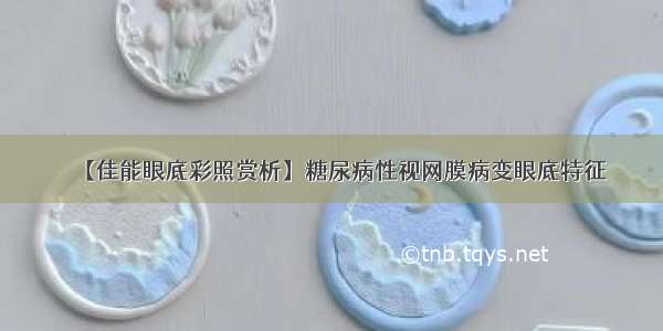 【佳能眼底彩照赏析】糖尿病性视网膜病变眼底特征