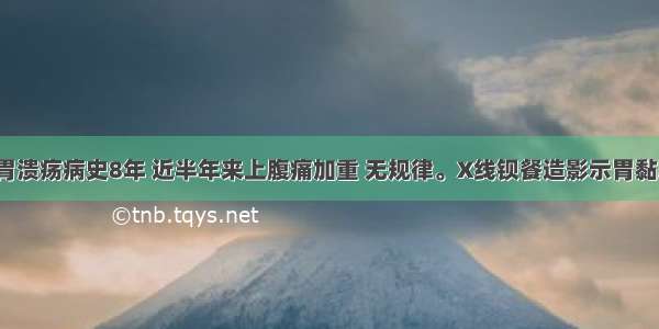 男 55岁。胃溃疡病史8年 近半年来上腹痛加重 无规律。X线钡餐造影示胃黏膜皱襞增粗