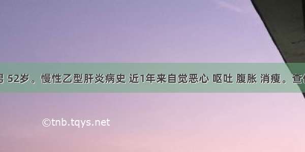 患者男 52岁。慢性乙型肝炎病史 近1年来自觉恶心 呕吐 腹胀 消瘦。查体可见