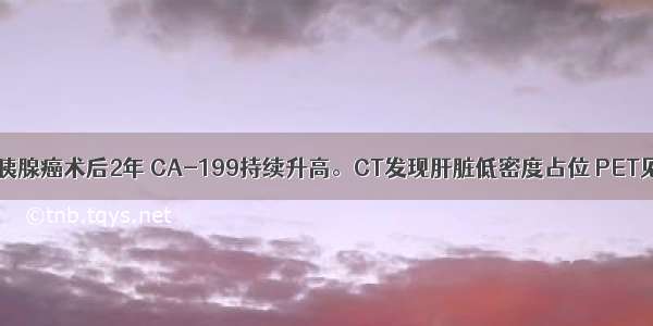 男性 63岁。胰腺癌术后2年 CA-199持续升高。CT发现肝脏低密度占位 PET见FDG代谢增