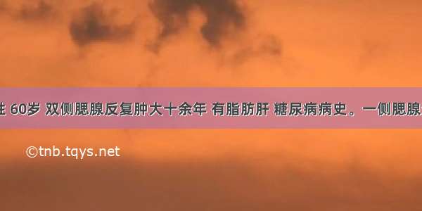 患者 女性 60岁 双侧腮腺反复肿大十余年 有脂肪肝 糖尿病病史。一侧腮腺造影显示